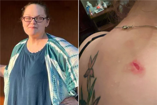 子弹卡在脂肪层 美国女子遇歹徒连中7枪奇迹生还!_wishdown.com 子弹卡在脂肪层 美国女子遇歹徒连中7枪奇迹生还!_wishdown.com