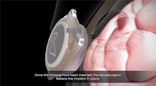 1.5秒植入!马斯克脑机接口公司技术新突破 超万人等待上脑_wishdown.com 1.5秒植入!马斯克脑机接口公司技术新突破 超万人等待上脑_wishdown.com