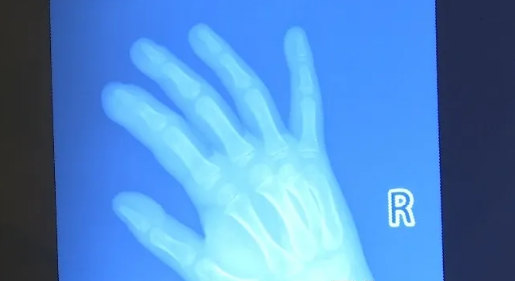 ����5����ͯ�������ضȸ�Ⱦ�ֹ� ҽ���������շ�ŧ��Ѫ֢