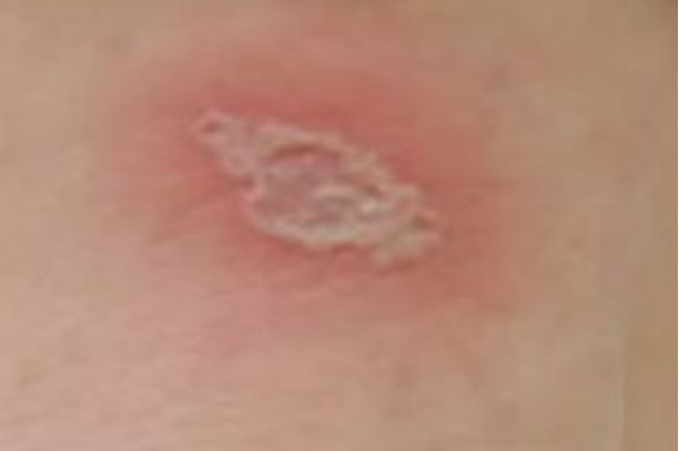 隐翅虫咬人后早期图片及症状一览_wishdown.com 隐翅虫咬人后早期图片及症状一览_wishdown.com