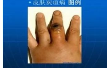 炭疽病是什么病有什么症状_wishdown.com 炭疽病是什么病有什么症状_wishdown.com