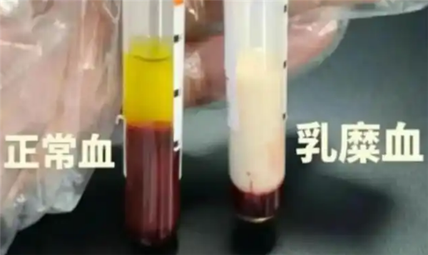 ���ӳ����ݮ����Ѫ ҽ���������ѣ�Ѫ֬����ƫ��Ҫע��