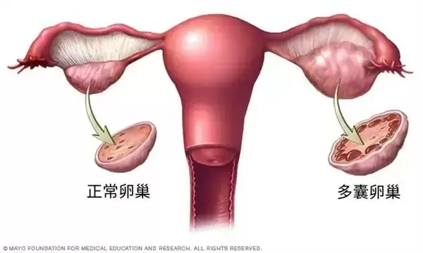 ���ڸ������ⲡ����ȫ��1.7��Ů�� ȴ���д�90��