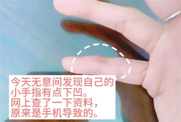 用小拇指做手机支架的受害者出现了:手指出现明显凹痕_wishdown.com 用小拇指做手机支架的受害者出现了:手指出现明显凹痕_wishdown.com